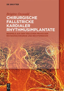Abbildung von Osswald | Chirurgische Fallstricke kardialer Rhythmusimplantate | 1. Auflage | 2021 | beck-shop.de