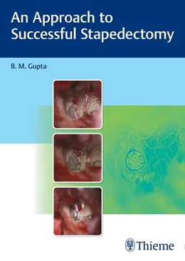 Abbildung von Gupta | An Approach to Successful Stapedectomy | 1. Auflage | 2022 | beck-shop.de