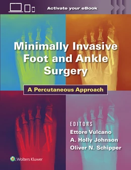 Abbildung von Vulcano / Johnson | Minimally Invasive Foot and Ankle Surgery | 1. Auflage | 2023 | beck-shop.de