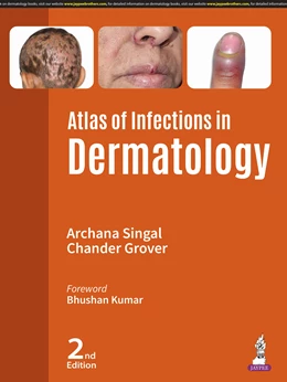 Abbildung von Singal / Grover | Atlas of Infections in Dermatology | 2. Auflage | 2024 | beck-shop.de