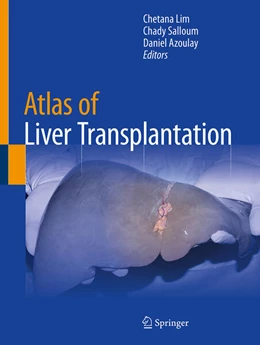 Abbildung von Lim / Salloum | Atlas of Liver Transplantation | 1. Auflage | 2025 | beck-shop.de