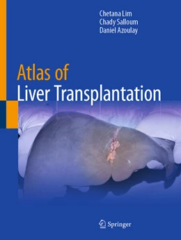Abbildung von Lim / Salloum | Atlas of Liver Transplantation | 1. Auflage | 2025 | beck-shop.de
